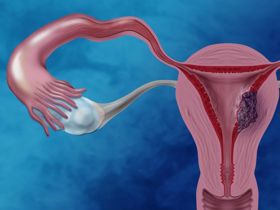 Đề phòng biến chứng của u nang buồng trứng thực thể