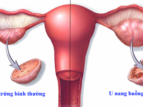 Gần 50% bệnh nhân u nang buồng trứng chưa sinh con