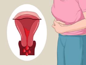 Rong kinh ở phụ nữ: Coi chừng u xơ tử cung