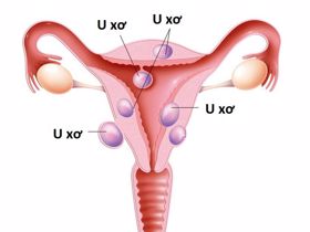 U xơ tử cung thường gặp ở thân tử cung
