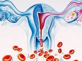 96% u xơ tử cung xuất hiện ở thân tử cung