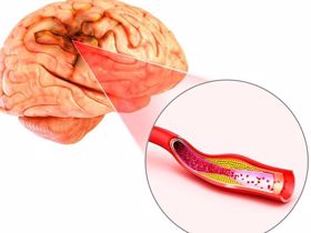 Dấu hiệu báo trước của tai biến mạch máu não