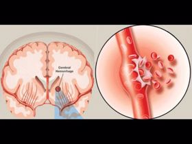 Nguy cơ tử vong do đột quỵ não