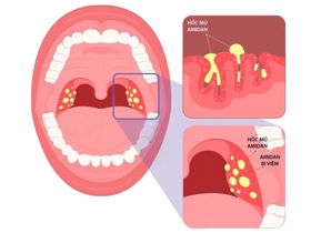 Viêm amidan hốc mủ có nên cắt không?