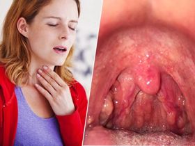 Cảnh giác với những biến chứng viêm họng hạt thường gặp