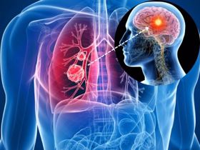THẮC MẮC: Ung thư phổi có thể di căn đến đâu?