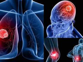 Ung thư phổi di căn và giải pháp phòng ngừa từ thảo dược