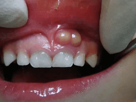 6 biện pháp loại bỏ và ngăn ngừa cao răng