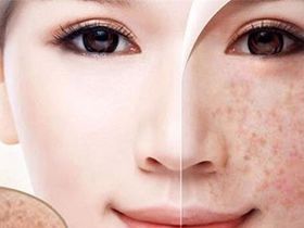 Nám da mặt và cách điều trị an toàn, hiệu quả