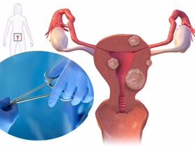 20% phụ nữ độ tuổi sinh đẻ mắc u xơ tử cung