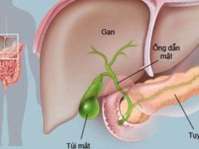 [Giải đáp] Vì sao sỏi vẫn tái phát sau phẫu thuật