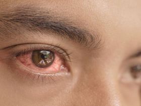 Làm gì để tránh lây đau mắt đỏ cho cả nhà?