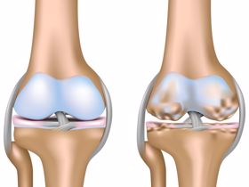 Không còn đi lại khó khăn do thoái hóa khớp gối