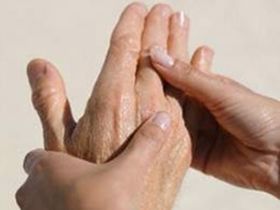 Viêm khớp dạng thấp: 90% bệnh nhân bị ở bàn ngón tay