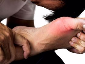Cẩn thận với bệnh gút nếu khớp ngón chân cái của bạn sưng đỏ