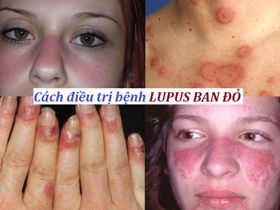 Điều trị bệnh lupus ban đỏ bằng cây thuốc dân gian