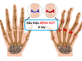 Nhận biết dấu hiệu bệnh gút ở tay như thế nào?