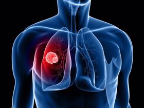 Xem ngay 5 dấu hiệu u phổi điển hình nhất bạn không nên bỏ qua