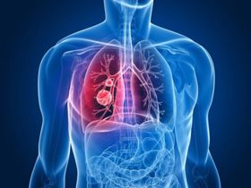 U phổi lành tính có nguy hiểm không? Xem ngay câu trả lời TẠI ĐÂY