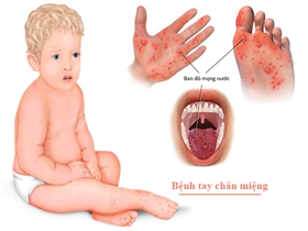Cảnh báo 3 biến chứng bệnh tay chân miệng ở trẻ cha mẹ cần lưu ý