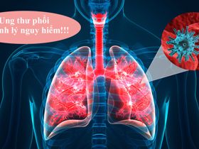 5 nguyên nhân gây ung thư phổi ở phụ nữ - ĐỌC NGAY ĐỂ BIẾT! 