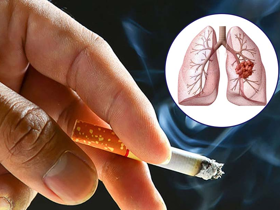Bệnh ung thư phổi và cách phòng tránh hiệu quả cho bạn và gia đình. XEM NGAY! 