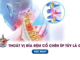 Thoát vị đĩa đệm cổ chèn ép tủy và giải pháp cải thiện từ thiên nhiên