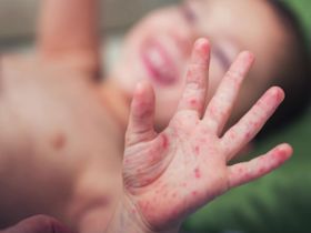 Trẻ bị tay chân miệng có cần uống kháng sinh không? Xem ngay thảo dược giúp cải thiện hiệu bệnh quả