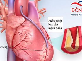 Tin vui: Bệnh viện Việt Đức khám miễn phí cho 100 người bị động mạch vành
