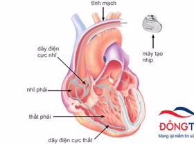 Điều trị bệnh tim bẩm sinh bằng máy tạo nhịp tim tái đồng bộ tại Việt Nam