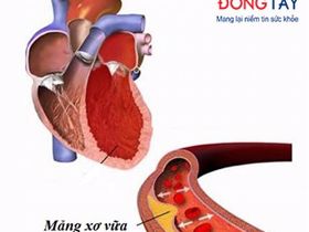 Cứu sống bệnh nhân nhồi máu cơ tim cấp bằng biện pháp can thiệp mạch vành