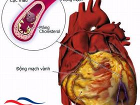  Suy tim - nguyên nhân, triệu chứng và điều trị