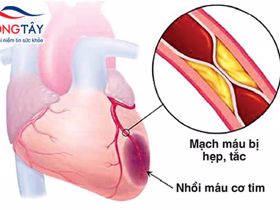 Thiếu máu cơ tim – dấu hiệu nhận biết và cách điều trị