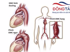 Chứng phình động mạch chủ - nguyên nhân và yếu tố nguy cơ