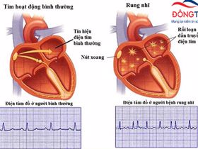 Rối loạn nhịp tim có những loại nào?