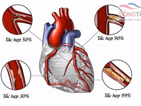 Tổng quan về bệnh xơ vữa động mạch vành tim