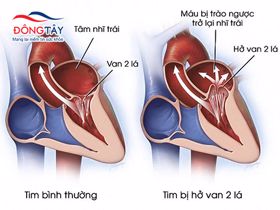 Những điều bạn nên biết về hở van tim 2 lá