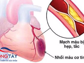 Nhồi máu cơ tim - biến chứng của xơ vữa động mạch vành 
