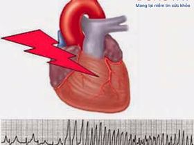Rối loạn nhịp tim - Bệnh lý tim mạch phức tạp