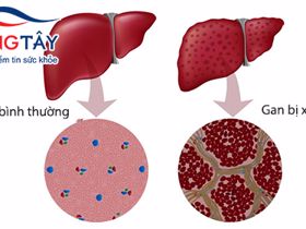 Đột phá mới giúp đảo ngược quá trình xơ gan