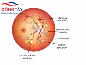 3 biến chứng mắt thường gặp nhất ở người bệnh đái tháo đường