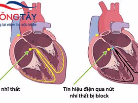 Block tim - thông tin đầy đủ về bệnh và cách điều trị