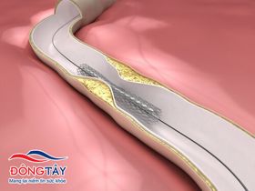 Tái tắc hẹp mạch vành sau khi nong vành và đặt stent
