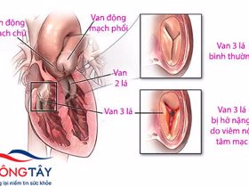 Hở van tim 3 lá 2/4 - 3 biến chứng nguy hiểm người bệnh cần tránh!