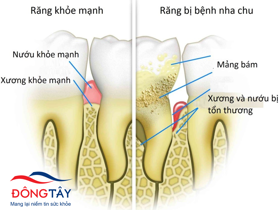 Những bệnh về răng miệng do tiểu đường