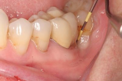 Chữa sâu răng bằng tỏi có hiệu quả không? THAM KHẢO NGAY