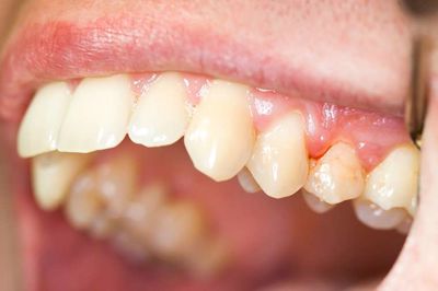 9 yếu tố gây nguy cơ mất răng sớm mà bạn nên biết