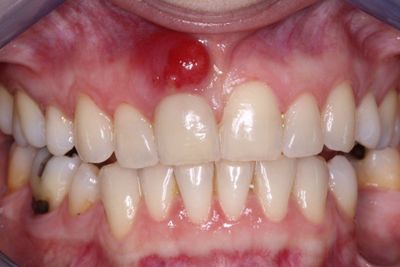 Top 5 cách chữa áp xe răng tại nhà hiệu quả! NOTE NGAY