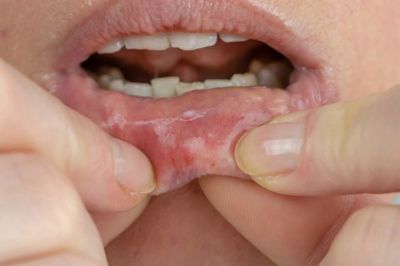 Viêm loét miệng (áp-tơ) là bệnh gì? Cách khắc phục ra sao?
