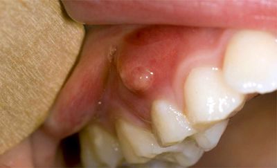 Sưng nướu răng và nổi hạch có nguy hiểm không?
